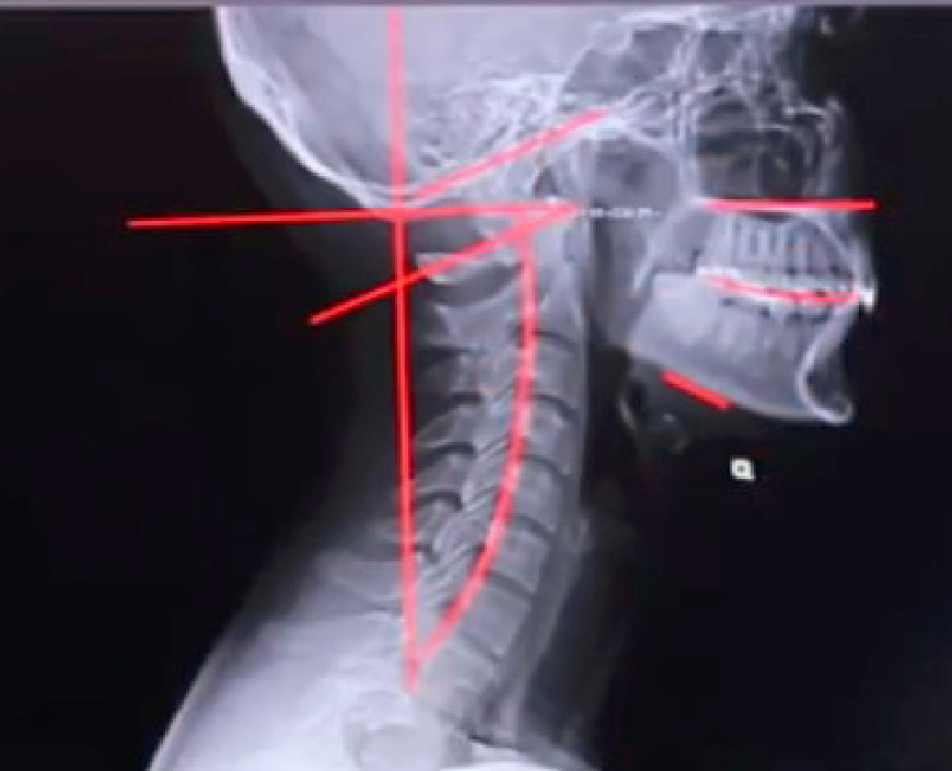 Skolioza i skrzywienia kręgosłupa 1 skolioza